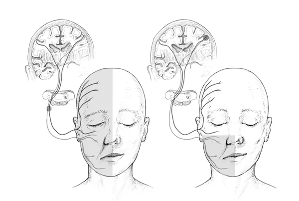 Facial